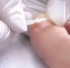 Praxismaterial*3TO Podostripe Spangen inkl. Tupfer